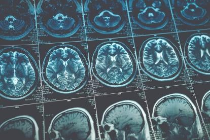 Traumatic Brain Injury in Personal Injury Law
