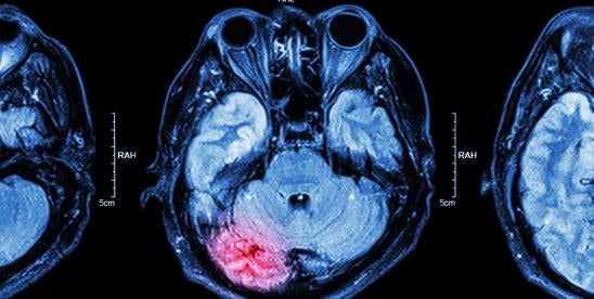Traumatic brain injury long-term effects